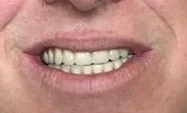 After full implant-dentures | Fleischmann Dentistry | Broomfield, CO